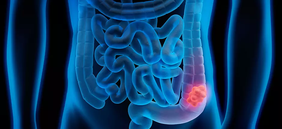 Novedad cáncer colorrectal _940x430