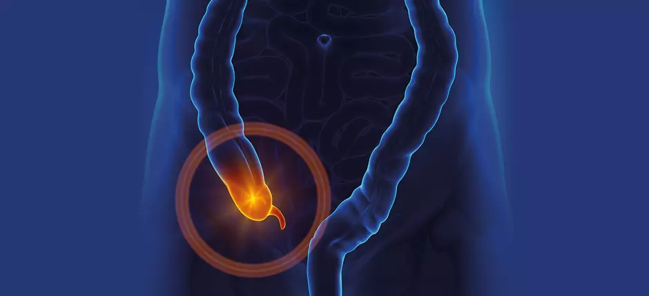 Novedad_apendicitis
