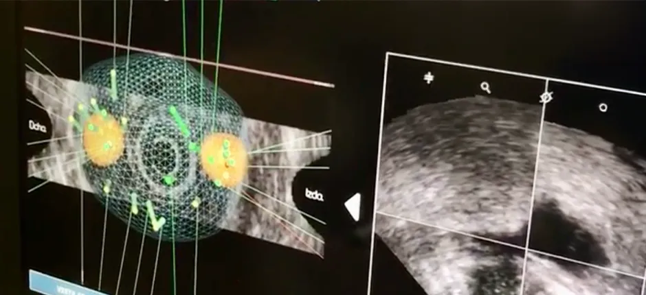 Biopsia por fusión transperineal: precisión y seguridad en el diagnóstico del cáncer de próstata