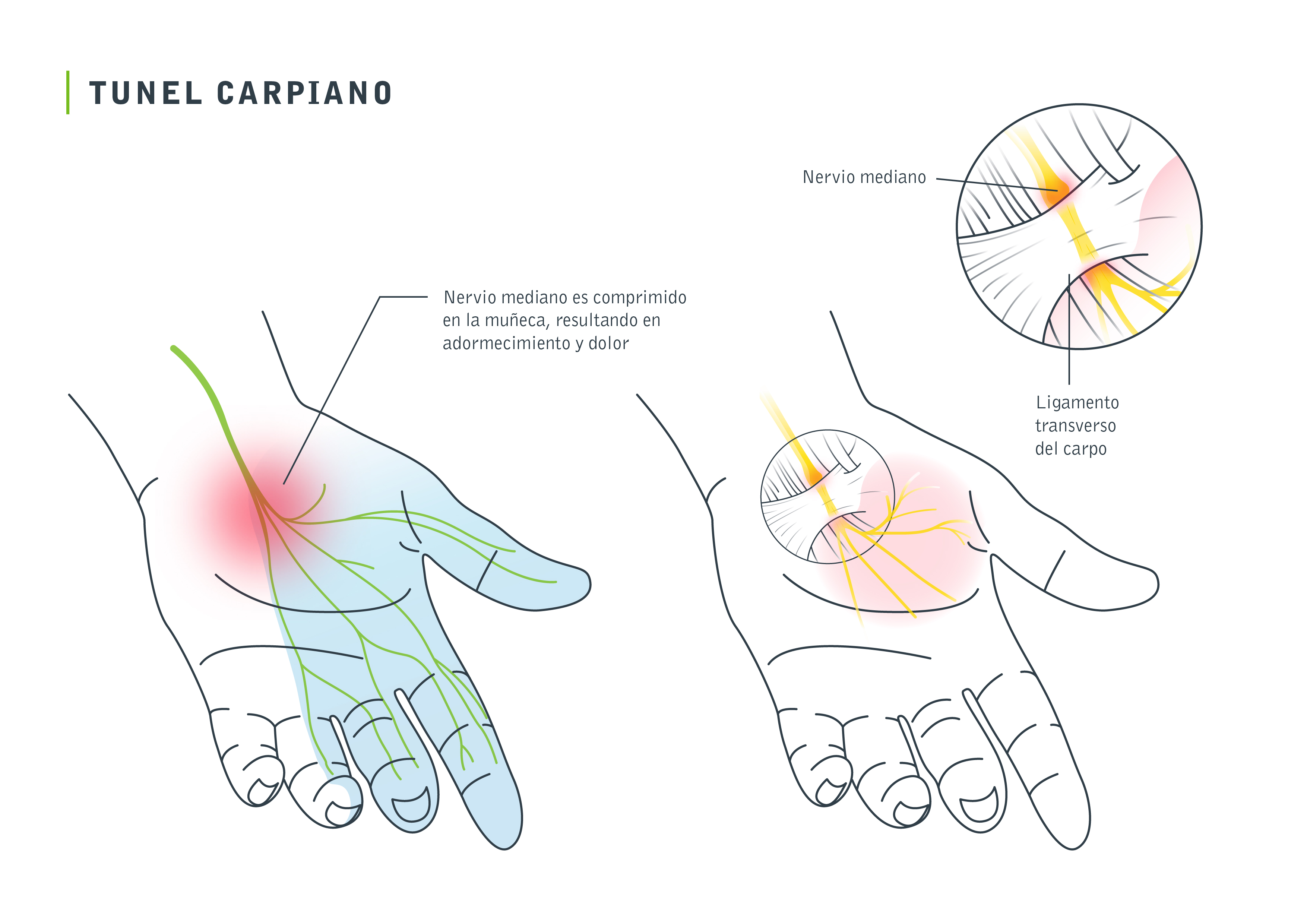 Sindrome del túnel carpiano. ¿Qué es?