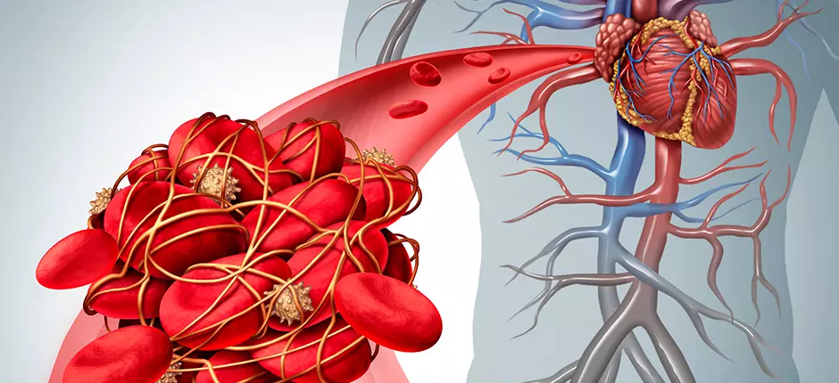trombosis-en-personas-jovenes-por-que-se-presenta-y-que-riesgo-implica